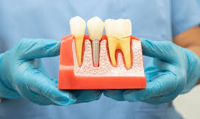 How To Get Dental Implants: Step-By-Step Guide